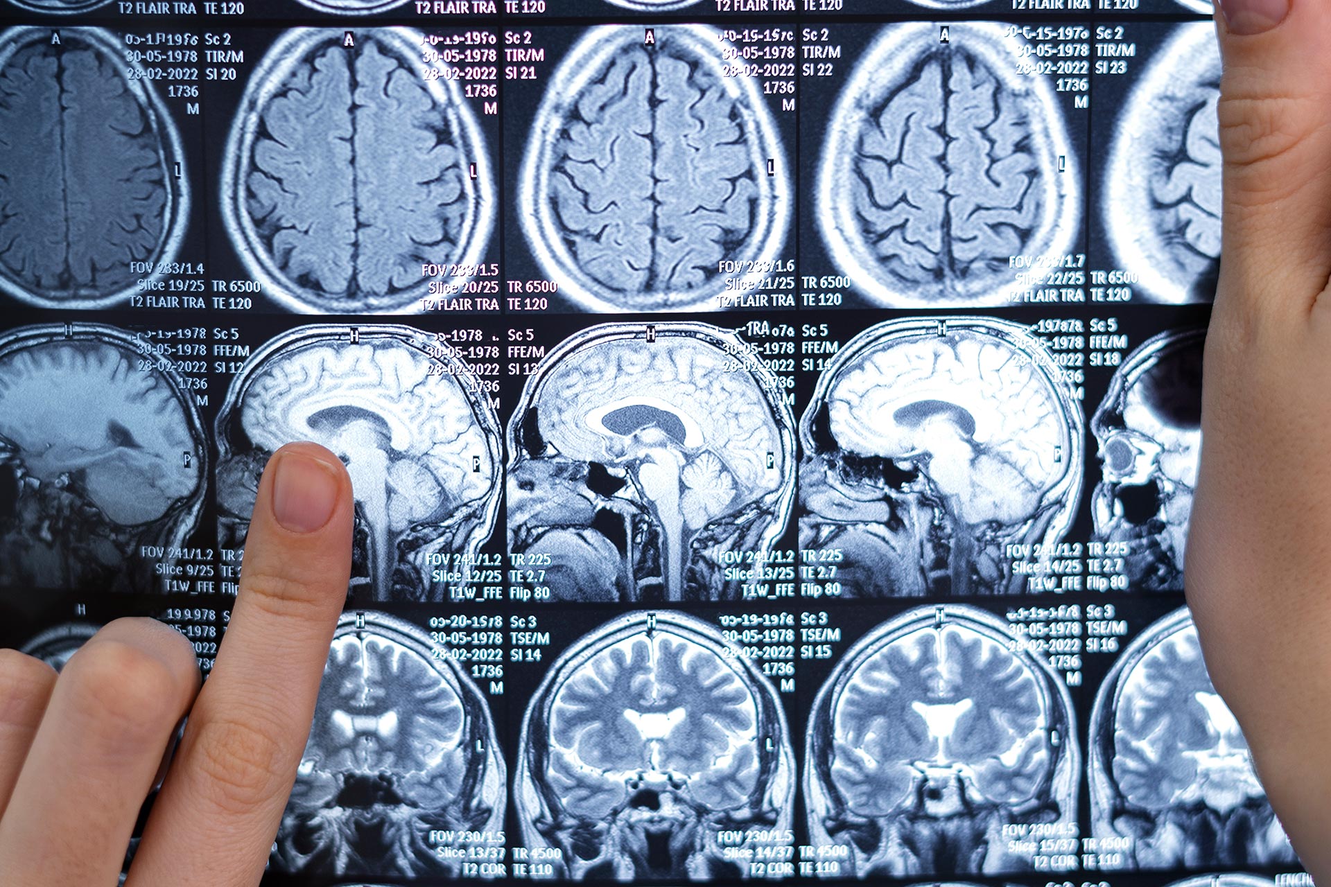 Un 1er essai pilote de traitement des tumeurs cérébrales basé sur un combo de 2 génériques publié